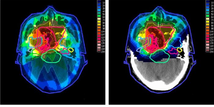Radiotherapy Not Effective for Secondary Brain Tumors