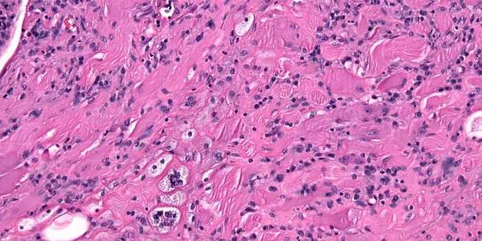 Auto-antibody Detection for Rheumatoid Arthritis Patients