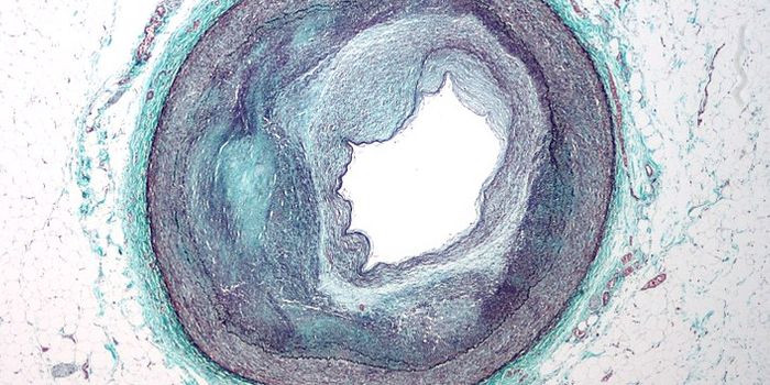 An Anti-Atherosclerosis Vaccine