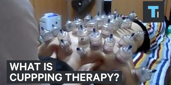 Does Cupping Really Work?