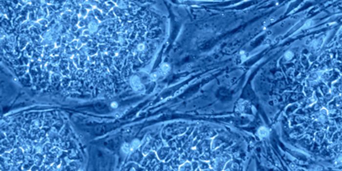 In a First, Stem Cell Therapy for Parkinson's in Human Patients