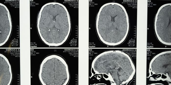 Brain Imaging May Predict Pediatric Response to Anxiety Medication: Study