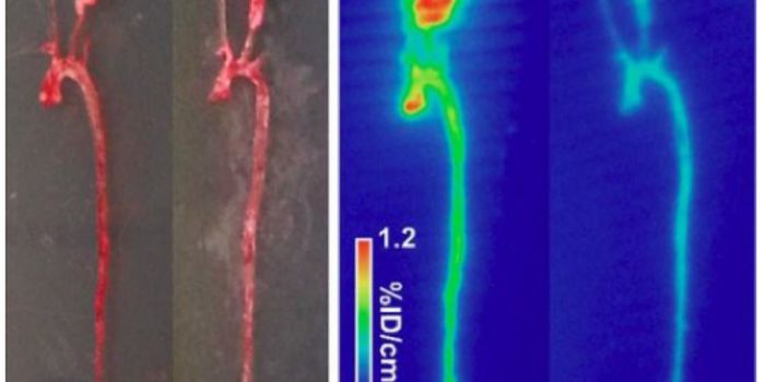 New imaging tracer allows better assessment of abdominal aortic aneurysm risk