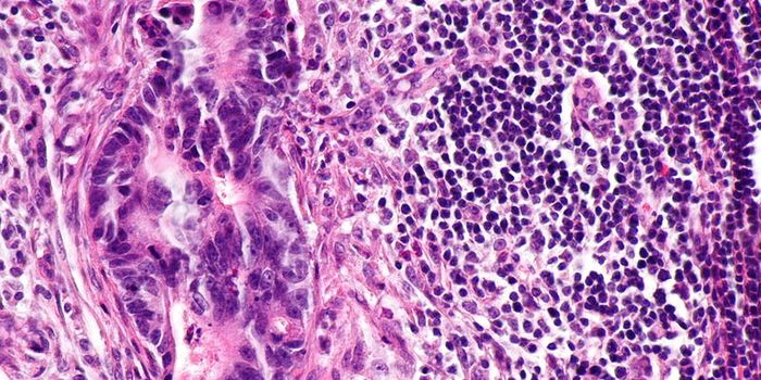 Early Differences Between Benign and Malignant Tumors