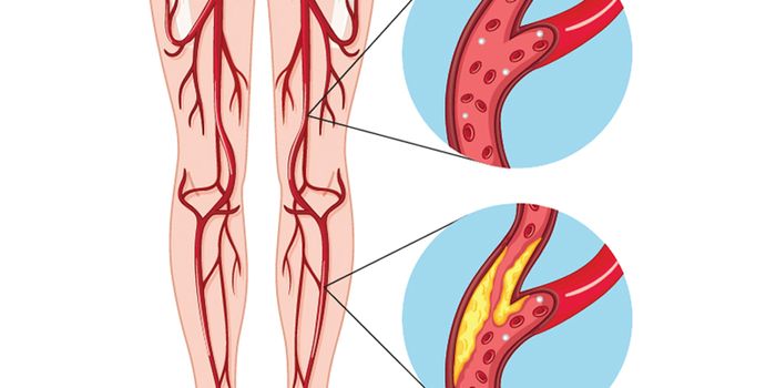 Alternative Therapy for Peripheral Artery Disease