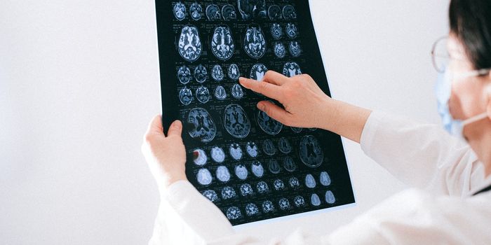 Schizophrenia Symptoms Linked to an Overactive Region of the Brain