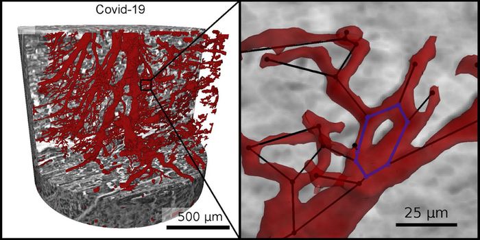 X-ray Technique Shows How COVID-19 Can Damage the Heart