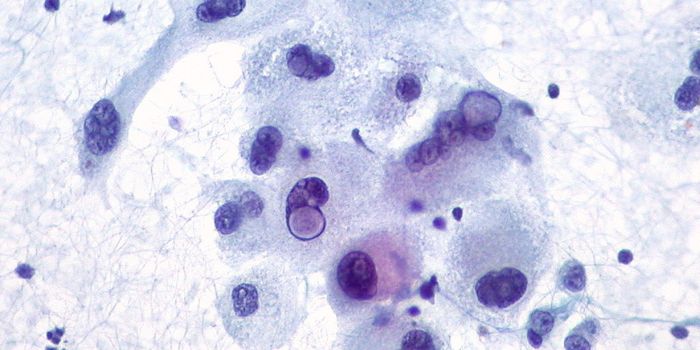 Immunotherapy Increases Survival of Melanoma Brain Metastases Patients