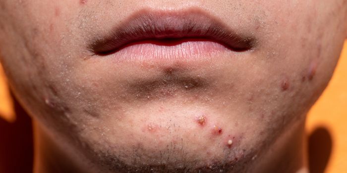 Using Nanoparticles to Treat Acne