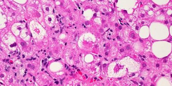 Injectable Drug reverses symptoms of liver disease in people with HIV