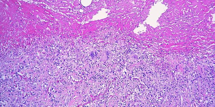 Vitamin A Gives Immune System Power to Fight Tuberculosis