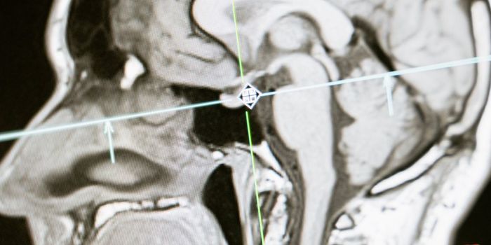 Excess Belly Fat Linked to Alzheimer's Disease