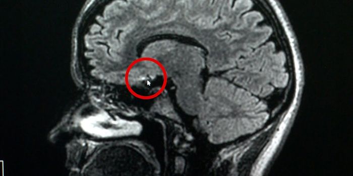 Get the Facts on Aneurysms