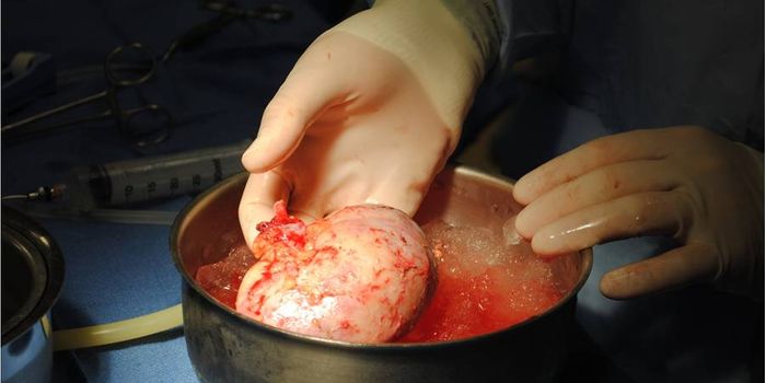 Procedure Allows Kidney Transplant from Any Donor