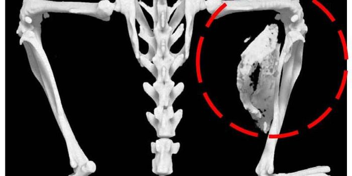 Inflammatory Molecules Linked to Rare Bone Growth Disease