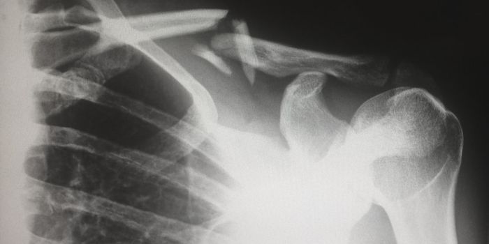 Common Asthmatic Treatments Increase Risk of Bone Fractures