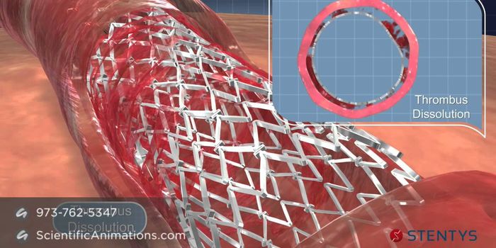 3D Animation of Coronary Stent Procedure