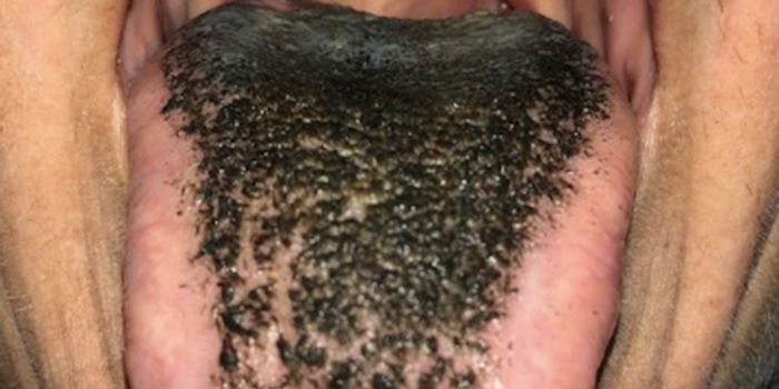 Black Hairy Tongue - A Shocking Antibiotic Side Effect