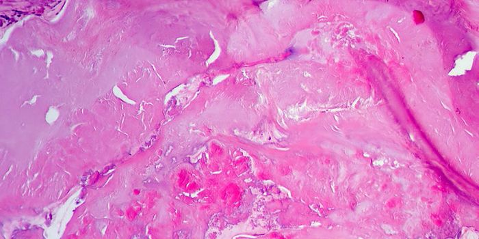 Heart Failure from Pressure Overload is Preventable