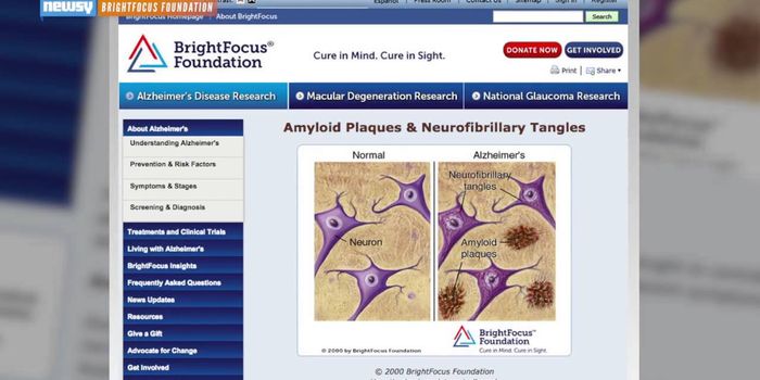 Alzheimer's Protein Plaque Found In 20-Year-Olds