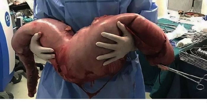 Diagnosed: Man Has 29 Pounds of Poop Removed from Colon