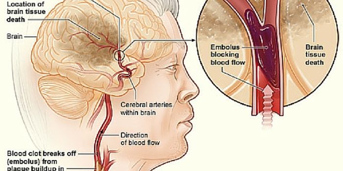 Younger Stroke Victims Don't Seek Treatment Fast Enough