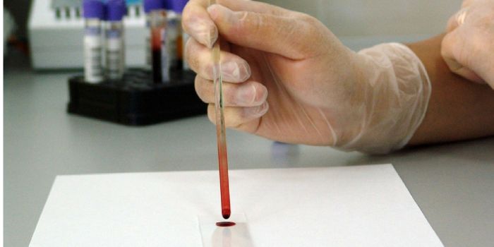 A New Blood Test to Diagnose Parkinson's Disease