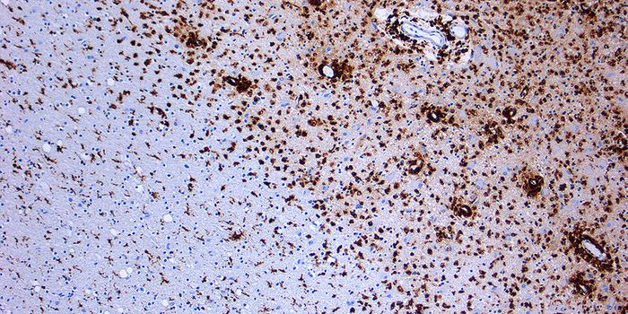 Testosterone Makes A Difference When It Comes to Multiple Sclerosis