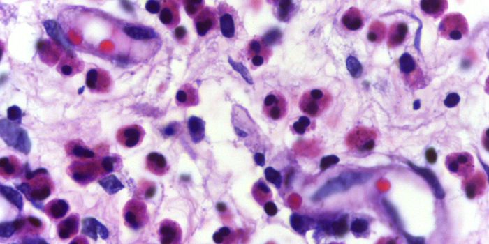 Treating A Rare Immunological Disease with Mepolizumab