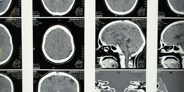 Hearing Loss Linked to 7% Increased Dementia Risk