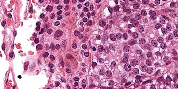 Genetic Changes can Help Diagnose Childhood Cancers Far Earlier