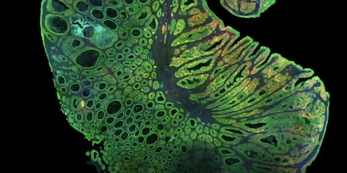 A Look at the Tumor Microenvironment