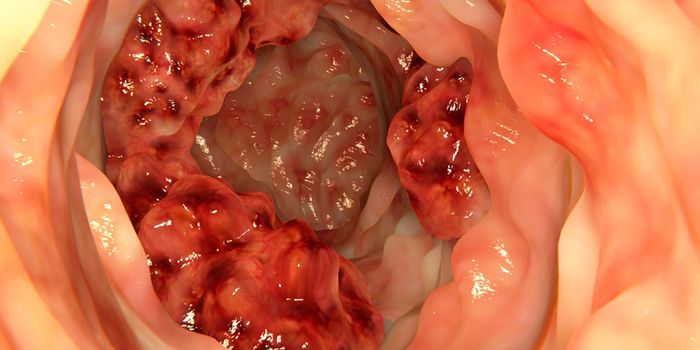 Metabolic Profile from Feces Reveals Colon Cancer Risks