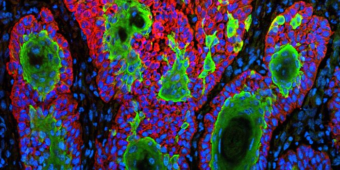 Why Do Promising Cancer Drugs Fail?