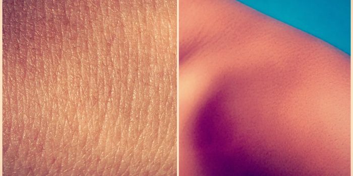 Skin Color Protein Used to Better Evaluate Skin Cancer