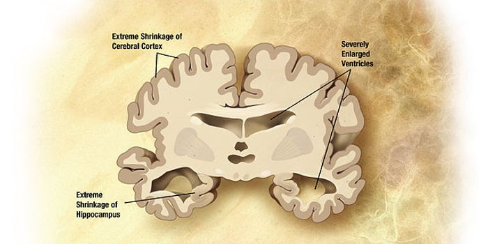 A Test for Alzheimer's Developed By British School Boy