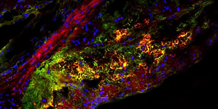 Natural Sugar Helps Macrophages Reduce Arterial Plaques