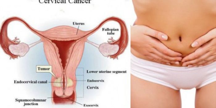 Scientists Find a Protein that Suppresses Cervical Cancer Growth