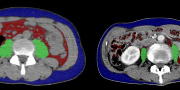 Efficacy of Cancer Therapeutics is Better When Muscle Mass is Normal
