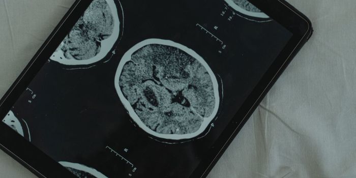 Moderate Alcohol Consumption Accelerates Alzheimer's Disease