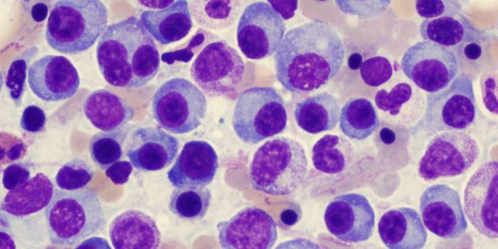 Genetic Profile of Myeloma Includes 8 New Variants