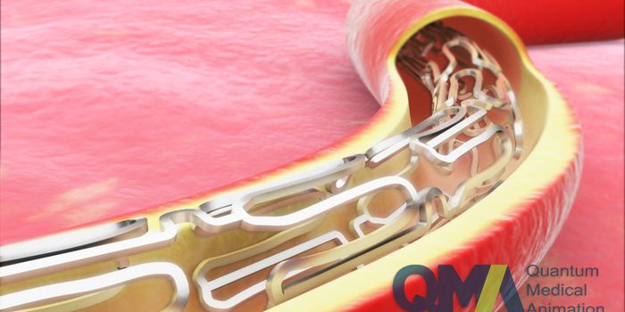 Improving Post-Heart Attack Stent Surgery