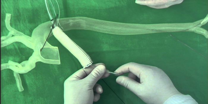 How A High-Risk Heart Surgery Changed in 10 Years