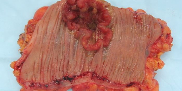 Why Cancer is Unavoidable Two-Thirds of the Time