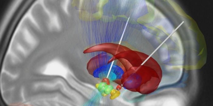 A New Form of Brain Stimulation for Parkinson's Patients