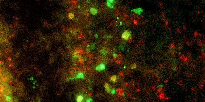 Brain Tumors May be New Victims of Ebola-like Virus