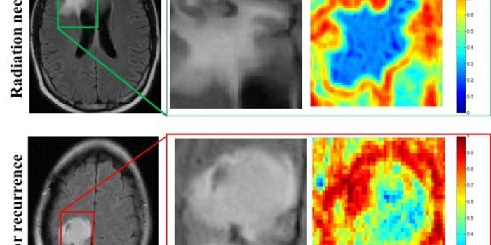 Machine Outperforms Doctors at Diagnosing Brain Cancer
