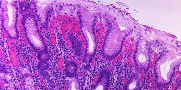 Small Clinical Trial Suggests New Edible Cholera Vaccine Is Safe