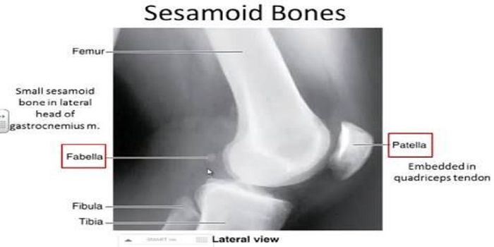 Increase in the Prevalence of Fabellae Over 150 Years
