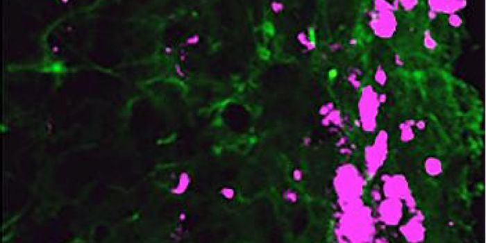 Ordinary Skin Cells Transformed Into Brain Tumor Assassinators